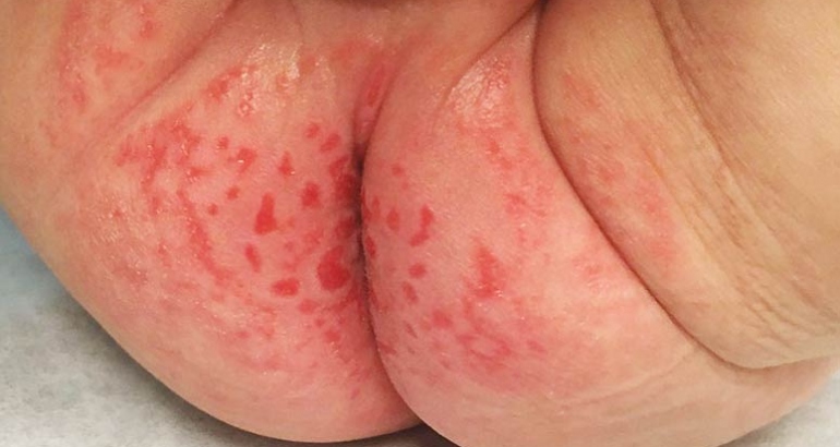 Dermatita de scutec la copii