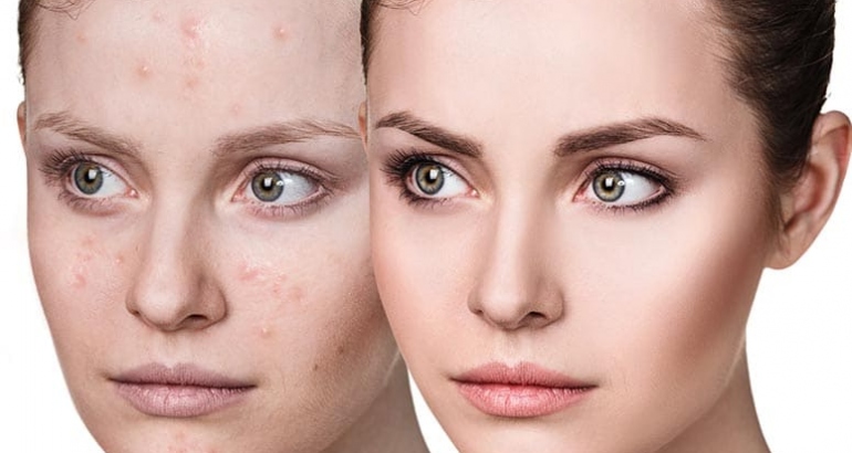 Tratament Laser acnee activă