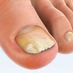 Tratament Laser onicomicoză