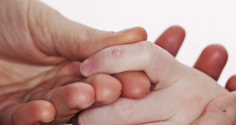 Tratament veruci vulgare ( negi ) la copii