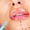 Mărire buze Acid Hialuronic