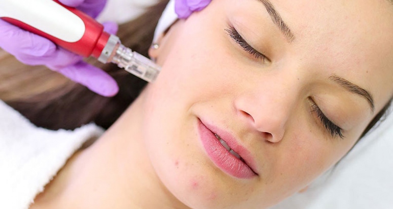 Dermapen – tratament riduri, vergeturi, cicatrici