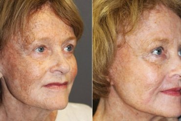 Ce este si la ce ajuta procedura de rejuvenare facială?