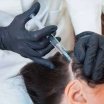 PRP scalp