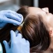 Mezoterapie scalp